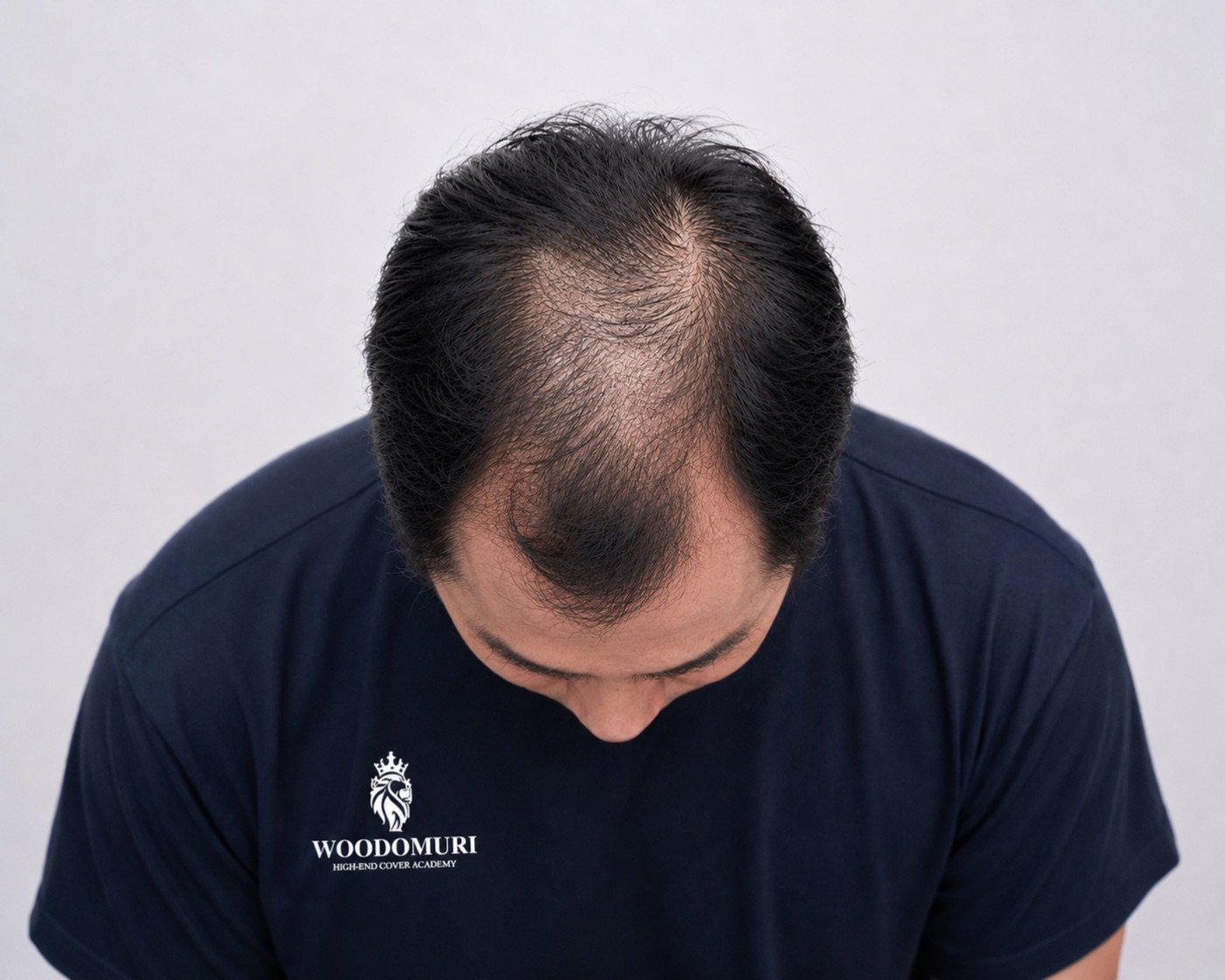 깊어진 M자 헤어라인 예시